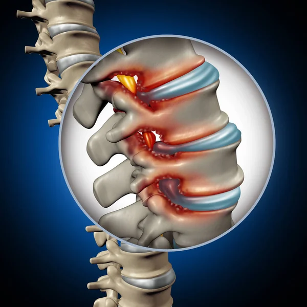 Spinal Stenosis: Osteoarthritis and Bone Spurs