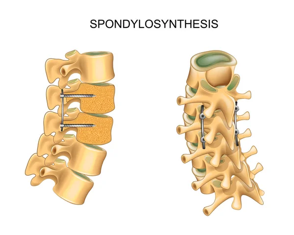 Spondylolisthesis: Spinal Fusion