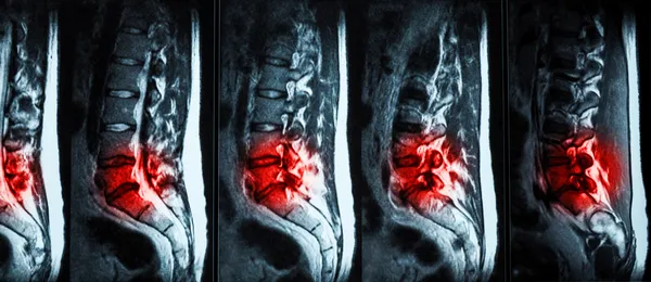 Herniated Disc: MRI