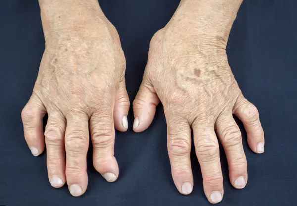 What is Arthritis: Common Symptoms for Arthritis