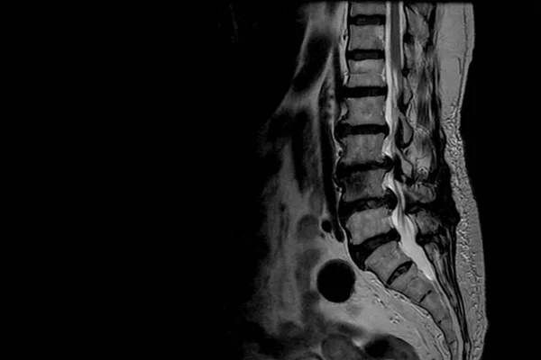 Degenerative Disc Disease: How Degenerative Disc Disease is Diagnosed
