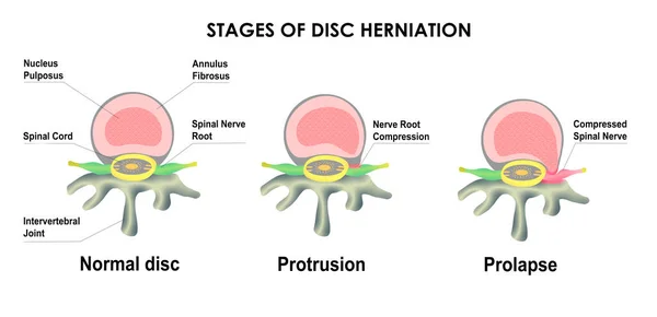 Herniated Disc: What is a herniated disc?