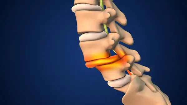 Spondylolisthesis: Types of Spondylolisthesis