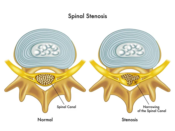 Spinal Stenosis: What is Spinal Stenosis?