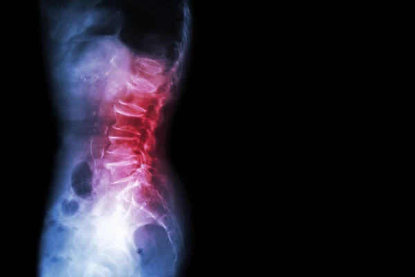 Spondylolisthesis: How Spondylolisthesis Is Diagnosed