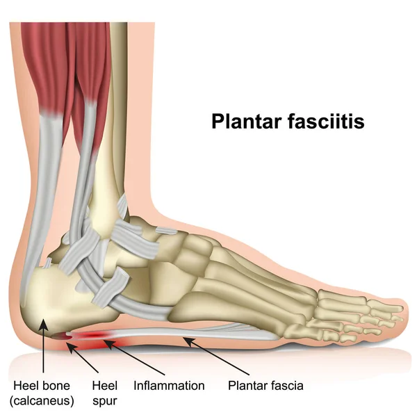 Tools for Plantar Fasciitis Recovery: Introduction