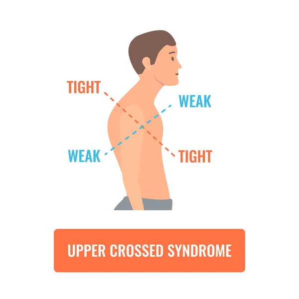 How Poor Posture Leads to Back & Neck Pain: Muscle Imbalances and Weakness