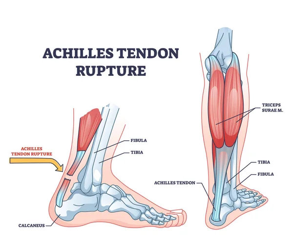 Achilles Rupture Recovery: What is an Achilles Tendon Rupture?