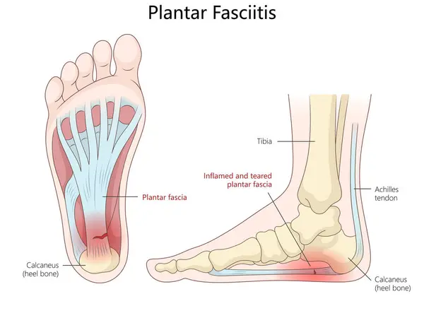 Understanding Plantar Fasciitis: What is Plantar Fasciitis?