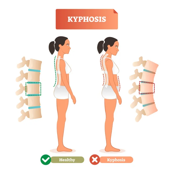 What is osteoporosis: Stooped Posture