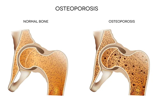 Best Exercises for Osteoporosis: What is Osteoporosis?
