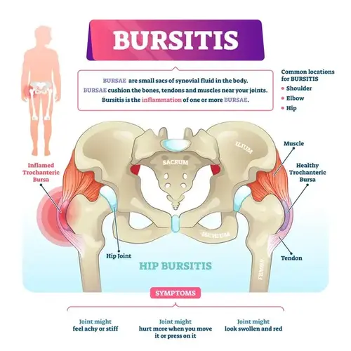 Exercises for Hip Bursitis: What is Hip Bursitis?