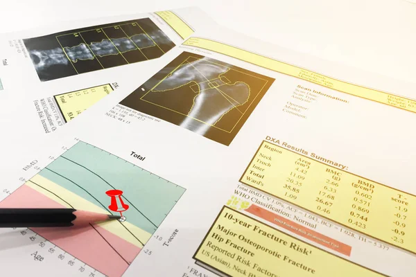 What is osteoporosis: What Can the Doctor Do?