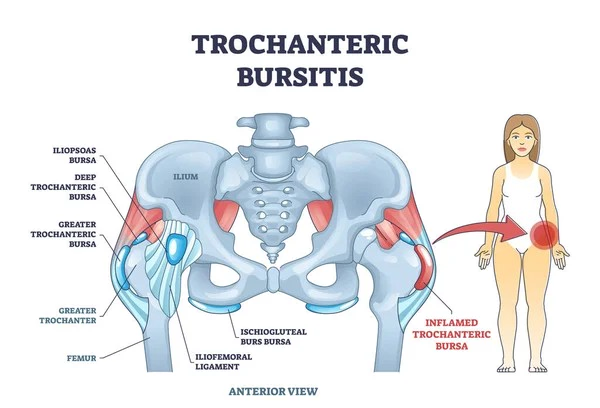 Trochanteric Bursitis: Where is the Trochanteric Bursa?