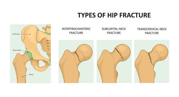 Rehab Tools for Hip Fracture Recovery: Why Rehab Tools Matter in Hip Fracture Recovery