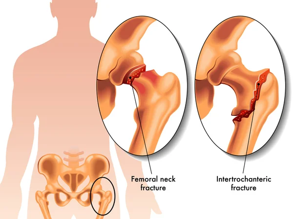 Hip Fractures from Falls: What is a Hip Fracture?