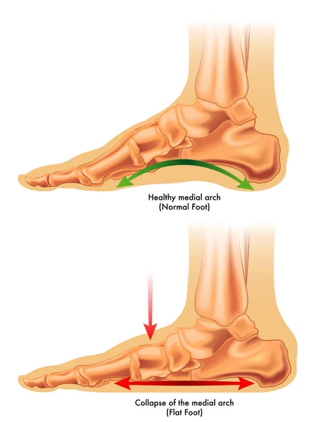 Stretches for Flat Feet: Why Stretches for Flat Feet Matter