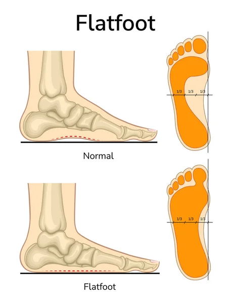 Flat Feet: What are Flat Feet?
