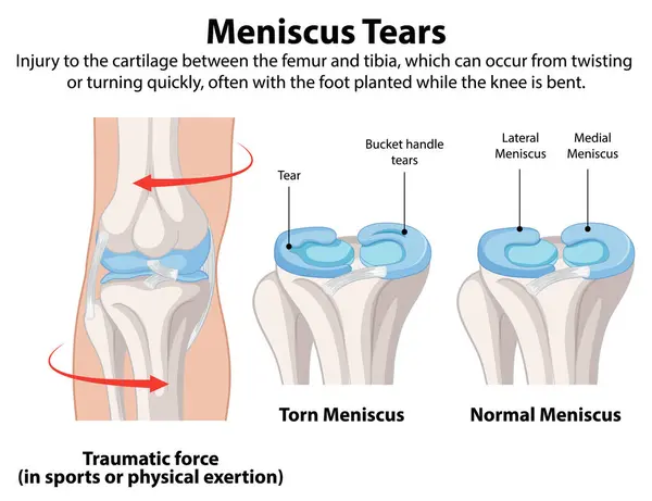 Exercises for Torn Meniscus Recovery: Why Exercises Matter for Torn Meniscus Recovery